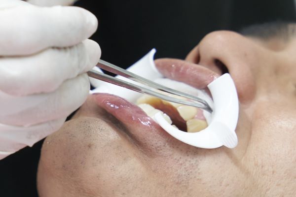 歯茎の保護